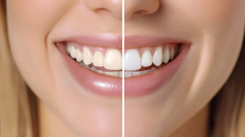 Nahaufnahme eines Lächelns mit direktem Vergleich der Zahnfarbe vor und nach dem Bleaching
