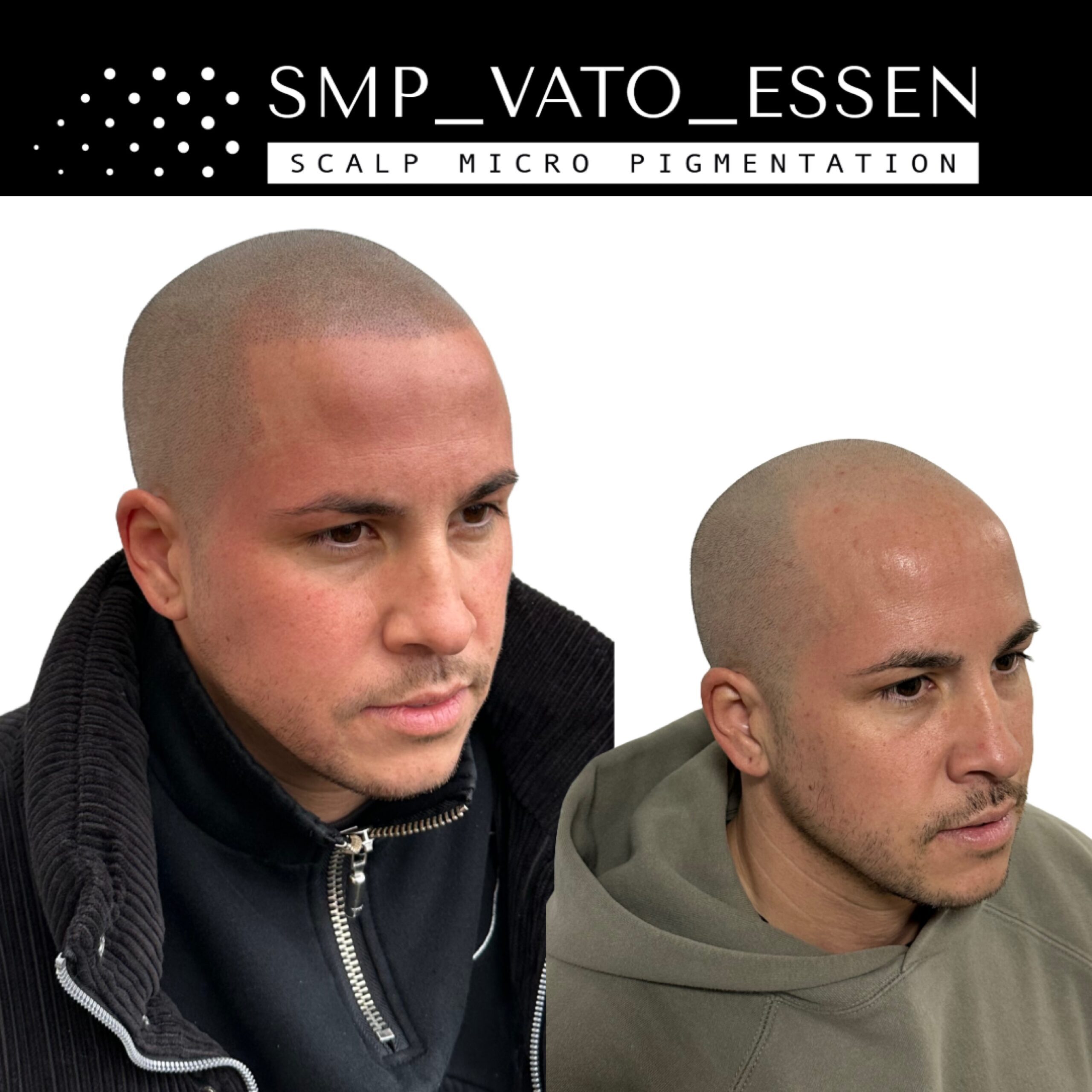 Vorher-Nachher-Vergleich einer Haarpigmentierung bei SMP Vato in Essen