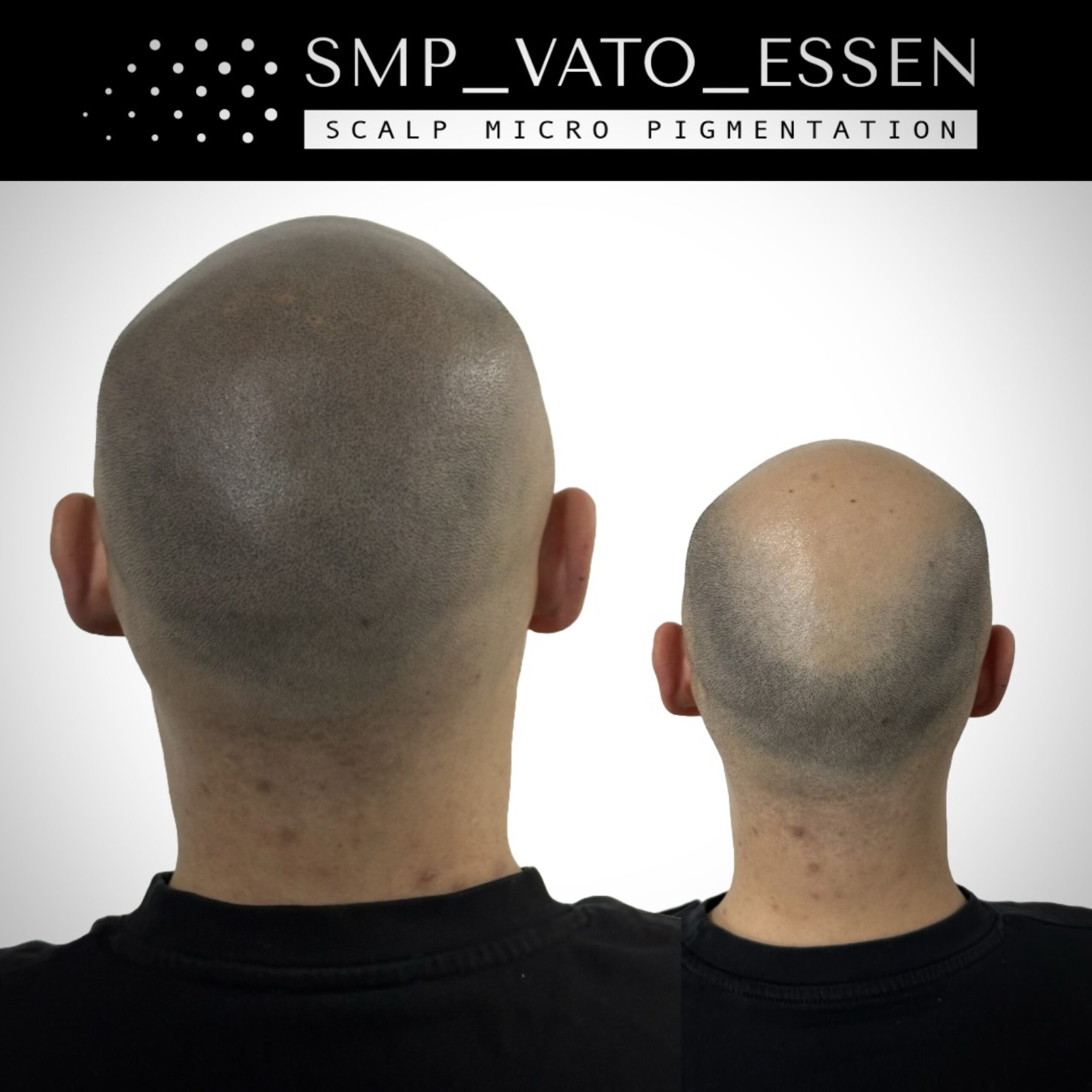 Vorher-Nachher-Bild einer Haarpigmentierung am Hinterkopf bei SMP Vato Essen