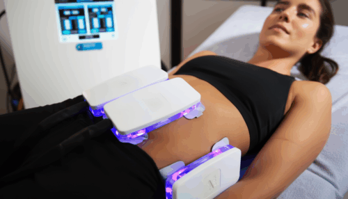 Kryolipolyse-Behandlung an Körperzonen nach Wahl